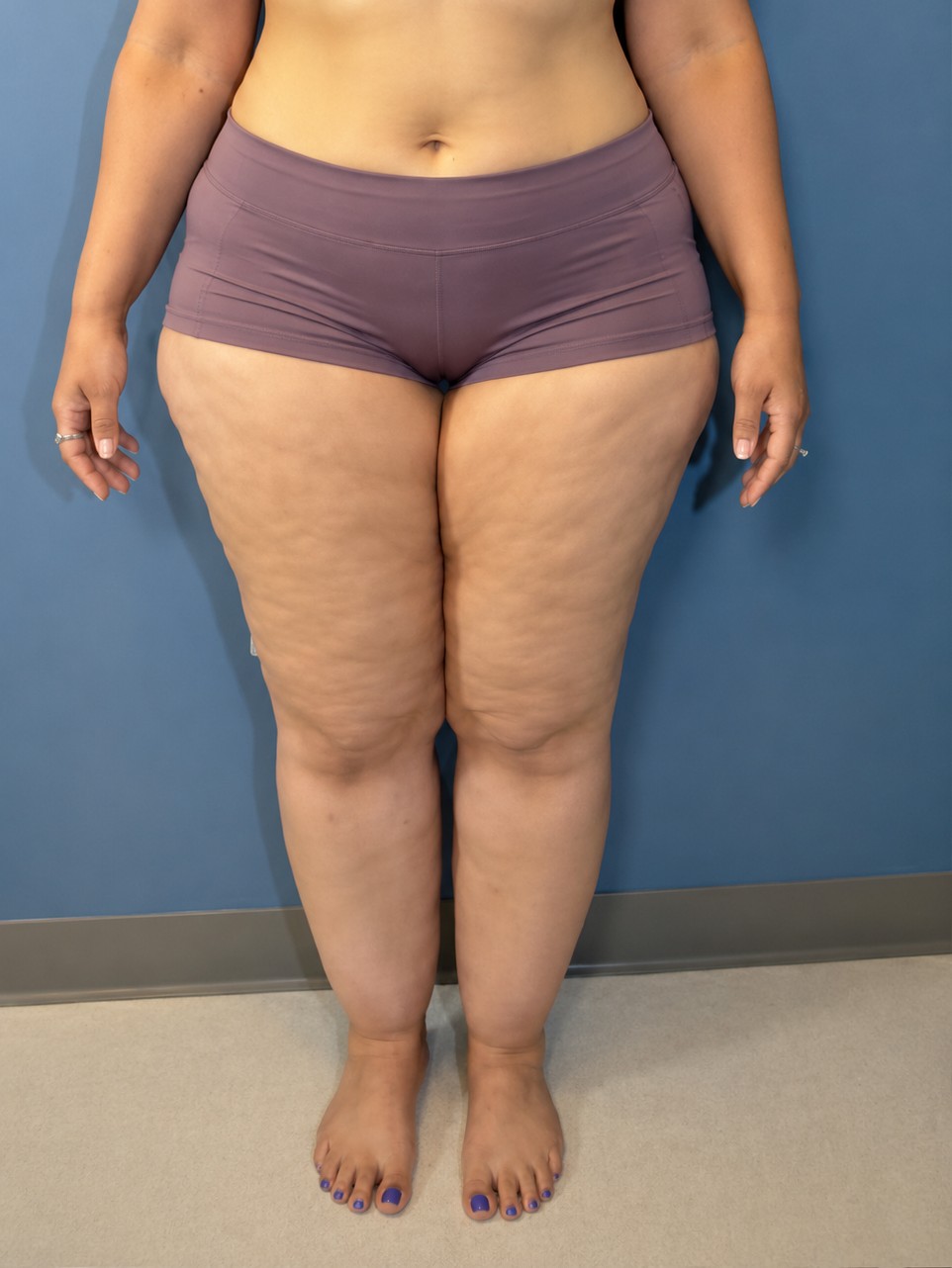 Acompanhamento médico do peso com lipedema pelo Método Secco Lipo